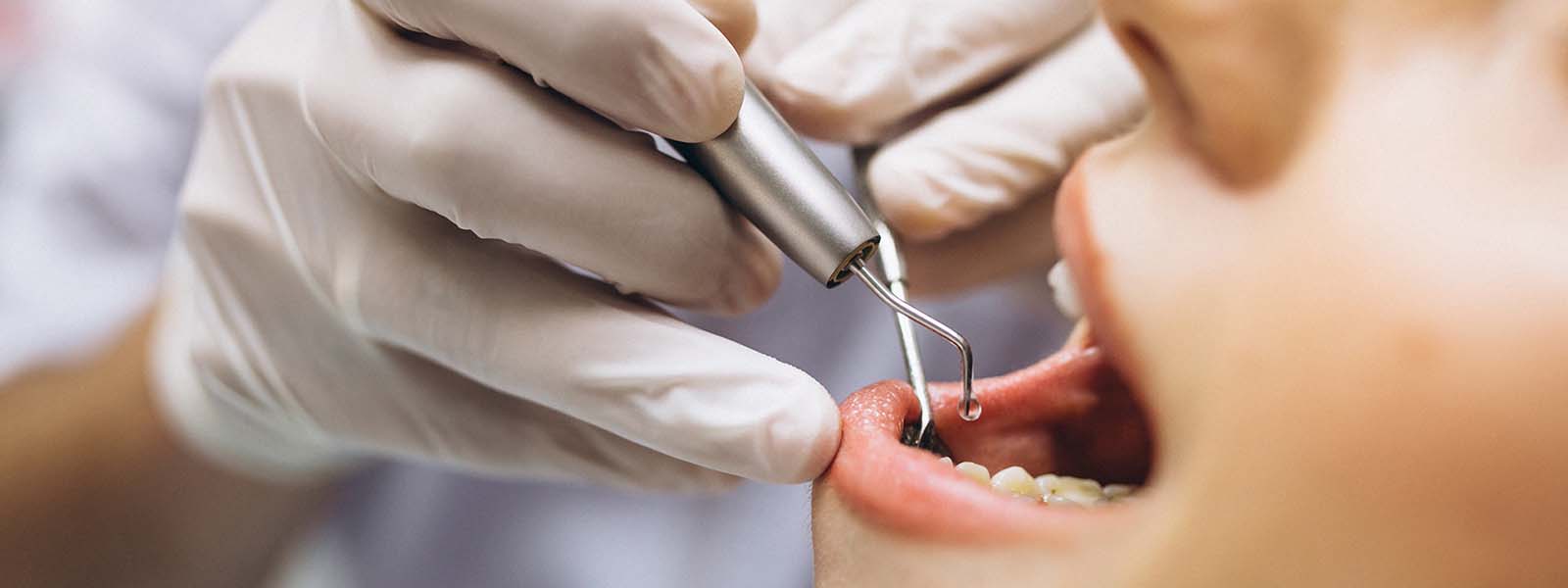 Se puede fumar despus de una limpieza dental? Se puede fumar despus de una limpieza dental?
